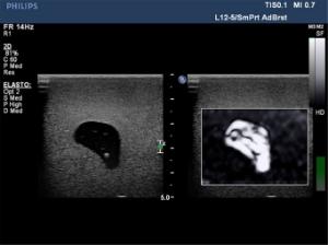 Elastography µltrasound breast phantom