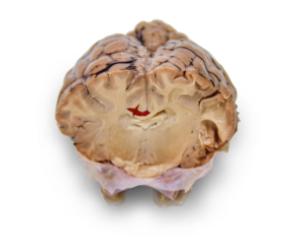 Preserved Sheep Brains with Simulated Tumors and Strokes