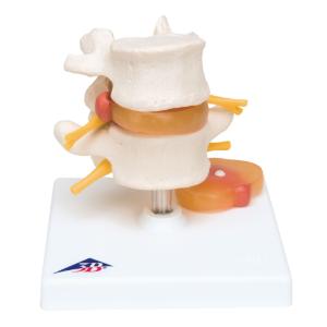 3B Scientific® Lumbar Spine With A Prolapsed Disc