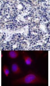 &#60;b&#62;Top Image:&#60;/b&#62; Immunohistochemical analysis of paraffin-embedded human breast carcinoma tissue using PKR (Ab-446).&#60;b&#62;Bottom Image:&#60;/b&#62; Immunofluorescence staining of methanol-fixed HeLa cells using PKR (Ab-446).