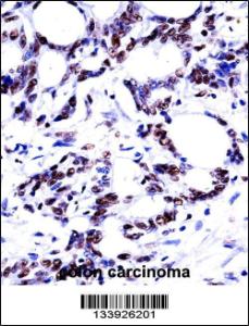HNRNPM Antibody immunohistochemistry analysis in formalin fixed and paraffin embedded human colon carcinoma followed by peroxidase conjugation of the secondary antibody and DAB staining