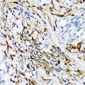 Immunohistochemistry analysis of paraffin-embedded human lung cancer using Anti-Proteasome 20S LMP2 Antibody [ARC1629] (A308367) at a dilution of 1:100 (40X lens). Perform microwave antigen retrieval with 10 mM Tris/EDTA buffer pH 9.0 before commencing with IHC staining protocol