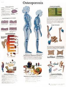 3B Scientific® Osteoporosis Chart