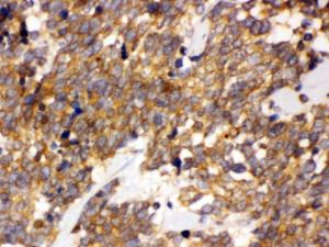 DDAH2 was detected in paraffin-embedded sections of human lung cancer tissues using rabbit anti- DDAH2 Antigen Affinity purified polyclonal antibody (Catalog # PB10001) at 1 ?g/ml. The immunohistochemical section was developed using SABC method (Catalog # SA1022).