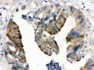 HMGB2 was detected in paraffin-embedded sections of human intestinal cancer tissues using rabbit anti- HMGB2 Antigen Affinity purified polyclonal antibody (Catalog # PB10002) at 1 ?g/ml. The immunohistochemical section was developed using SABC method (Catalog # SA1022).