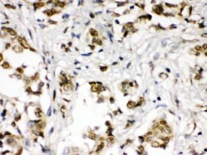 ABR was detected in paraffin-embedded sections of human mammary cancer tissues using rabbit anti- ABR Antigen Affinity purified polyclonal antibody (Catalog # PB9972) at 1 ?g/ml. The immunohistochemical section was developed using SABC method (Catalog # SA1022).
