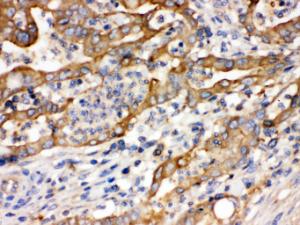 Alpha Actinin 4 was detected in paraffin-embedded sections of human intestinal  cancer tissues using rabbit anti- Alpha Actinin 4 Antigen Affinity purified polyclonal antibody (Catalog # PB9974) at 1 ?g/ml. The immunohistochemical section was developed using SABC method (Catalog # SA1022).