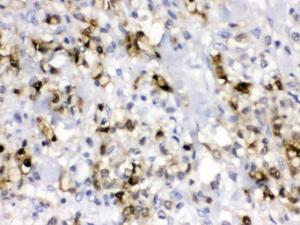 CA2 was detected in paraffin-embedded sections of human gastric cancer tissues using rabbit anti- CA2 Antigen Affinity purified polyclonal antibody (Catalog # PB9989) at 1 ?g/ml. The immunohistochemical section was developed using SABC method (Catalog # SA1022).