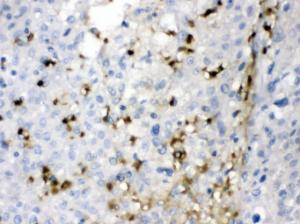 CA2 was detected in paraffin-embedded sections of human liver cancer tissues using rabbit anti- CA2 Antigen Affinity purified polyclonal antibody (Catalog # PB9989) at 1 ?g/ml. The immunohistochemical section was developed using SABC method (Catalog # SA1022).