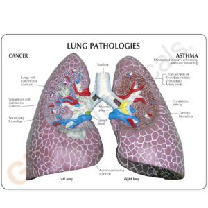 GPI Anatomicals® Lung Set with Pathologies Model